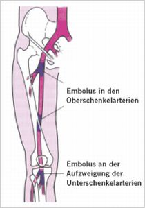 Mögliche Lage von Embolien in den Arterien des rechten Beines.